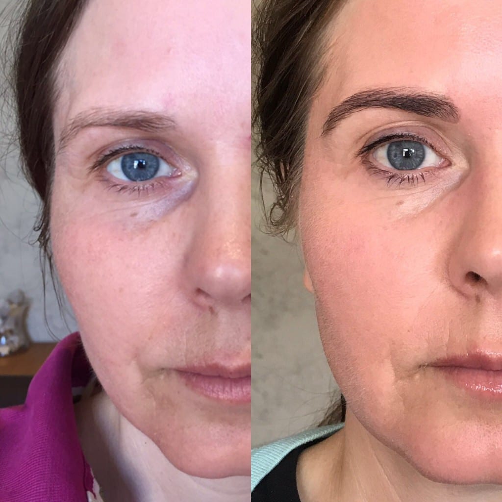BTL Exilis Elite Skin Tightening and Fat/Cellulite Reduction BTL Exilis Elite Skin Tightening and Fat/Cellulite Reduction