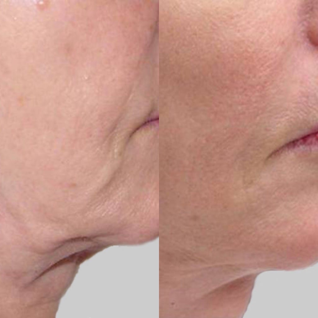 BTL Exilis Elite Skin Tightening and Fat/Cellulite Reduction BTL Exilis Elite Skin Tightening and Fat/Cellulite Reduction