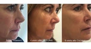 Profhilo Exeter - Skin Clinic - Skin South West